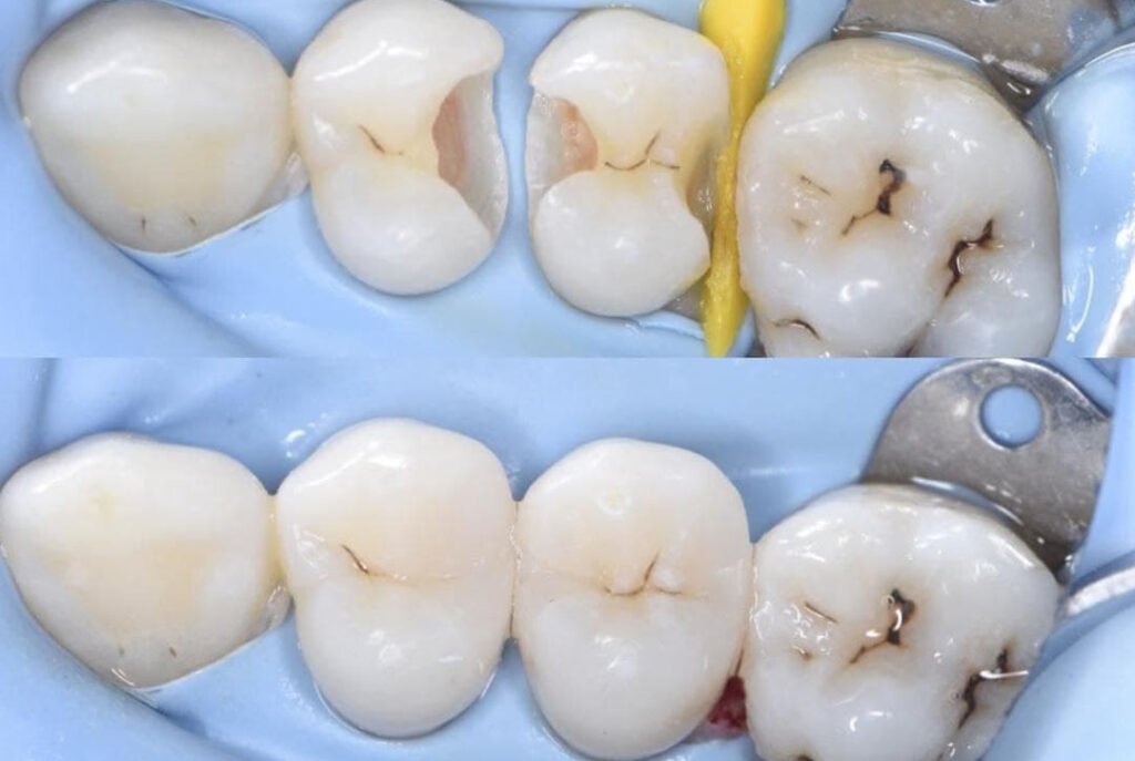 Why Do My Teeth Keep Breaking? A Prosthodontist Explains Teeth breaking