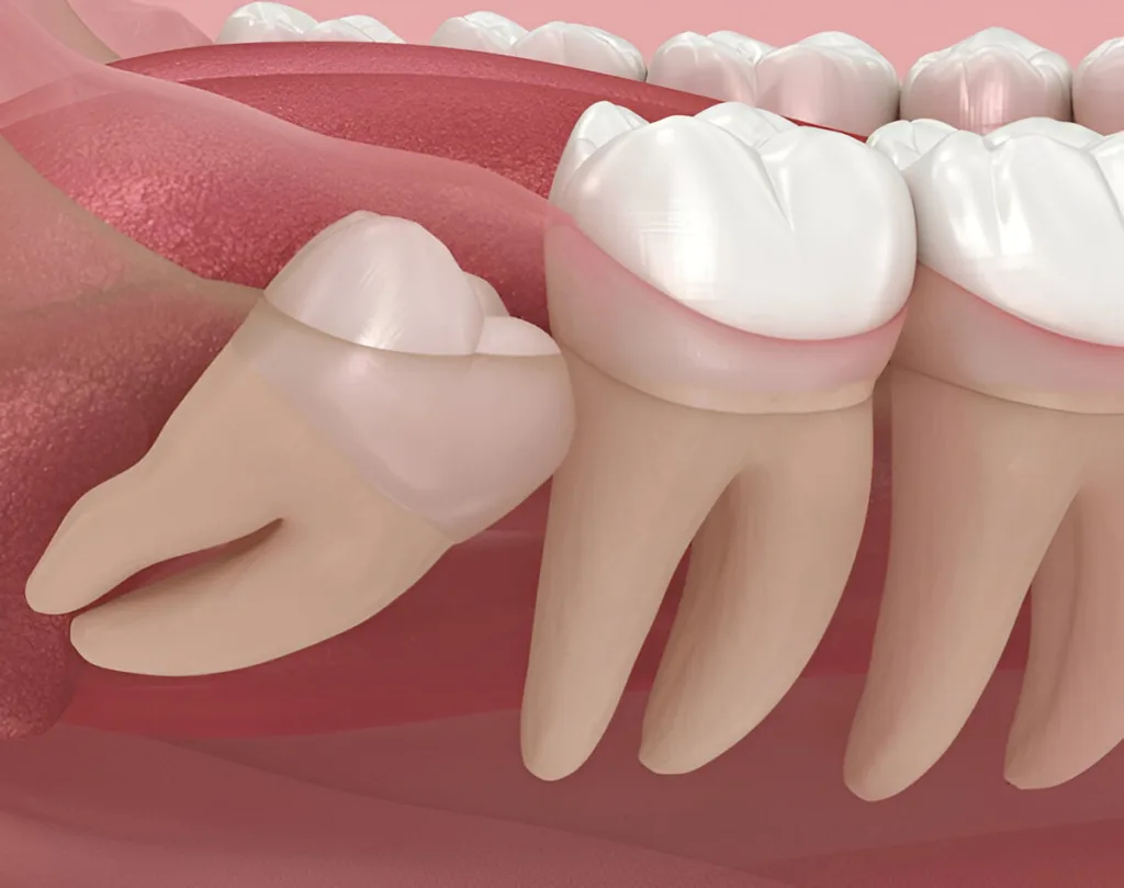 Wisdom Tooth Extraction Cost in Beirut (2026): Prices, Recovery & What to Expect lower wisdom teeth 1024x809