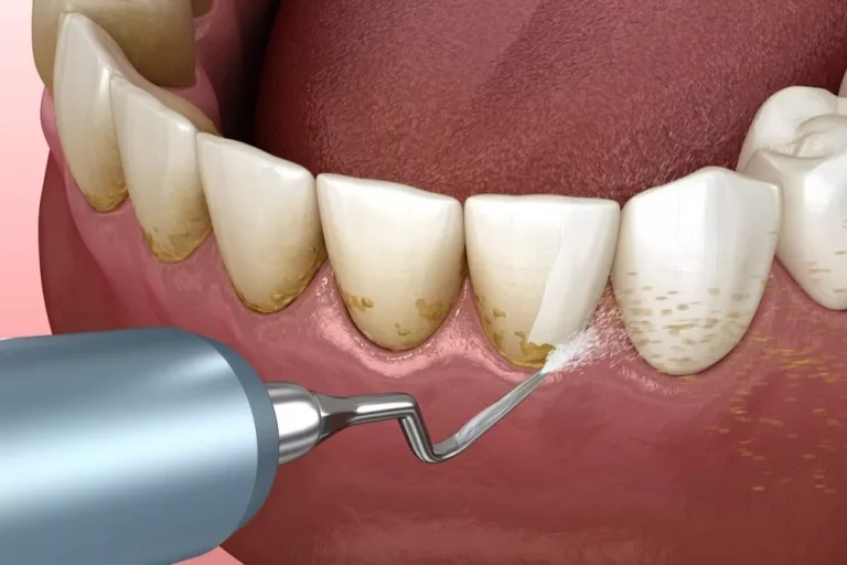 teeth cleaning
