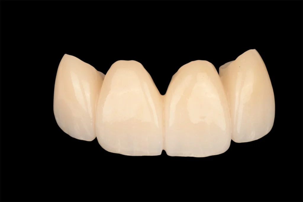 dental bridge beirut