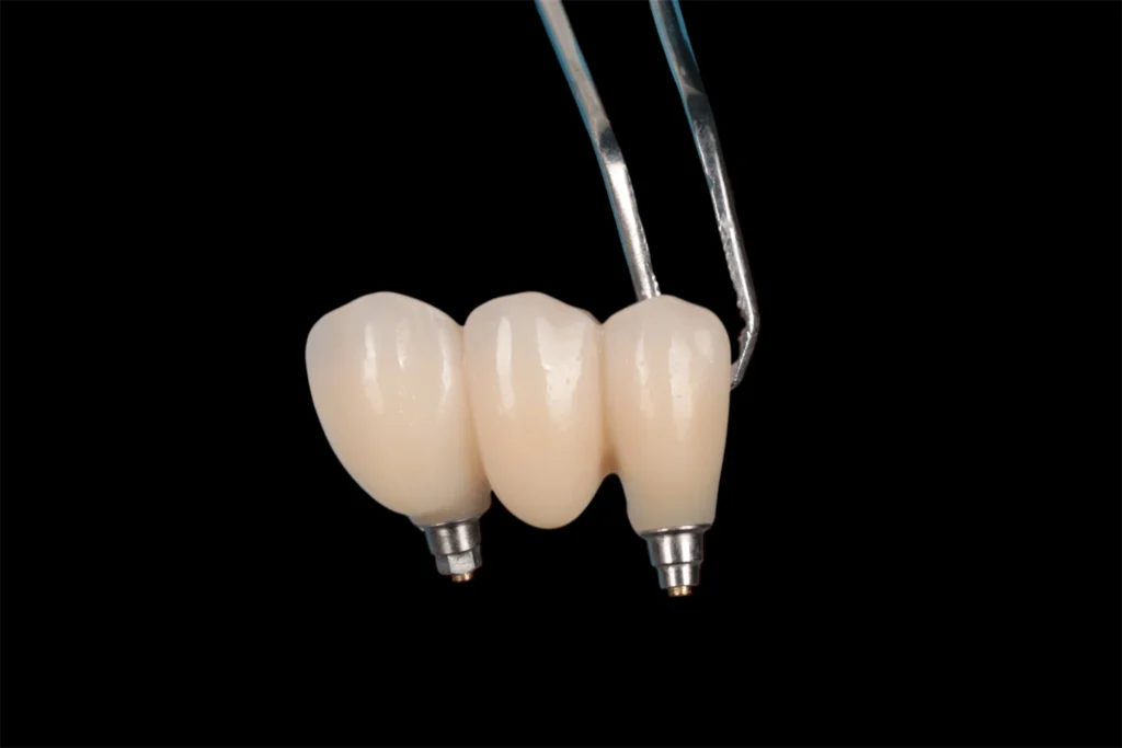 dental bridge on implants