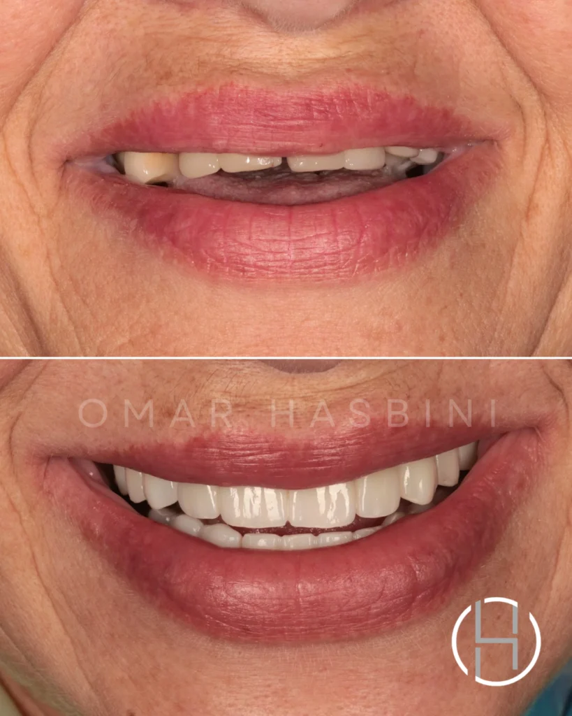 dental crowns beirut real case