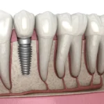 dental implant beirut