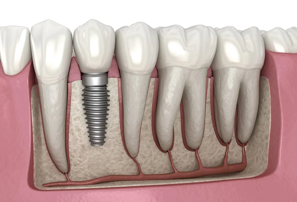 dental implant beirut