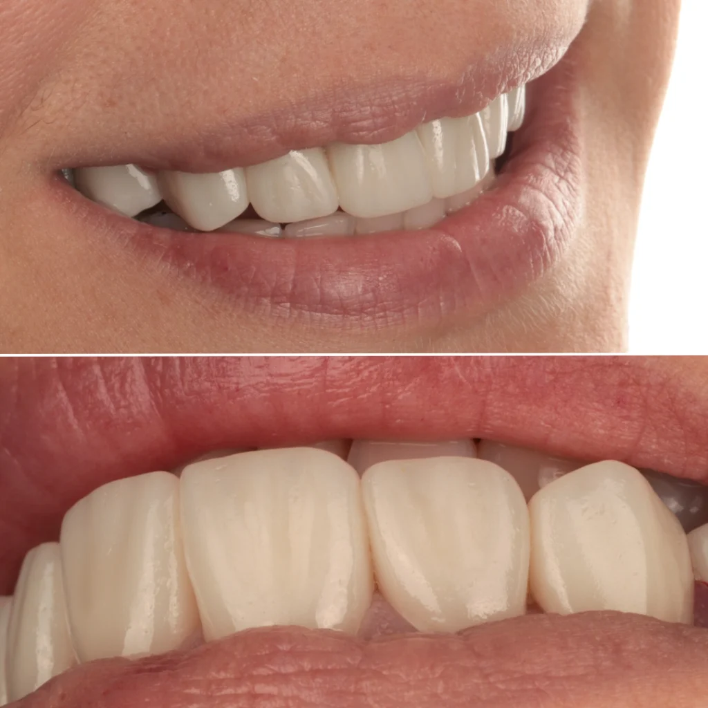 emax veneers beirut