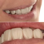 emax veneers beirut