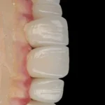zirconia crowns layered