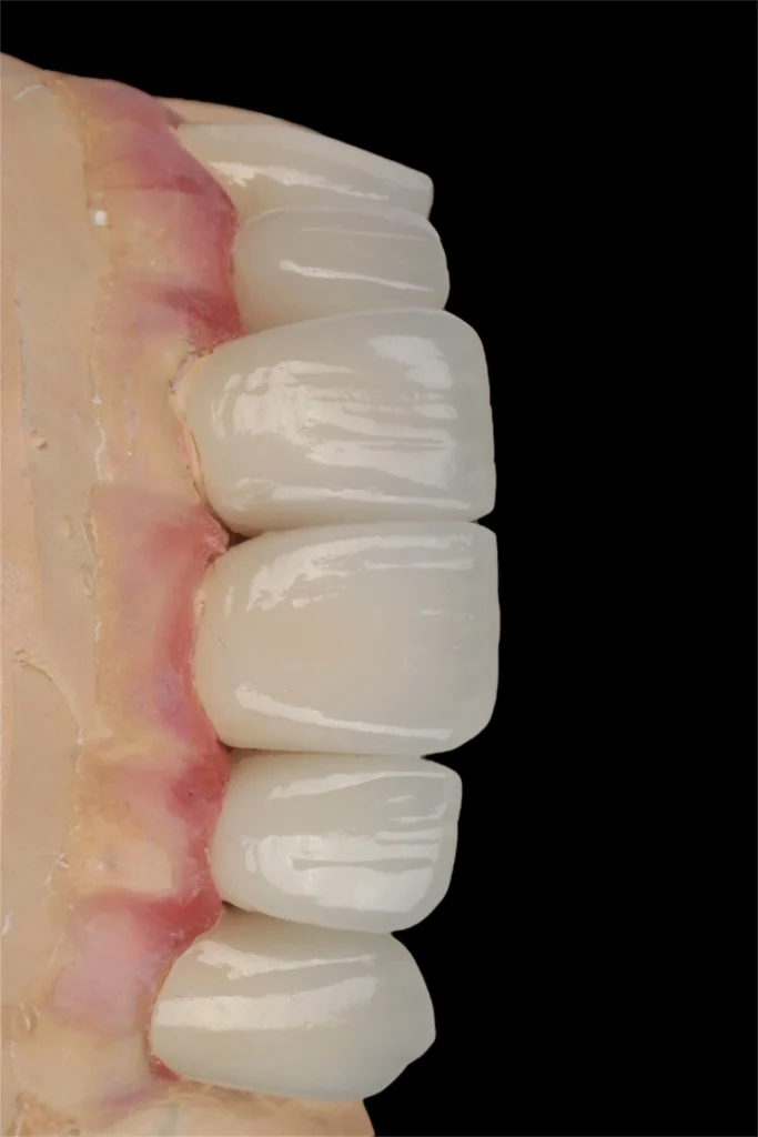 emax veneers in beirut