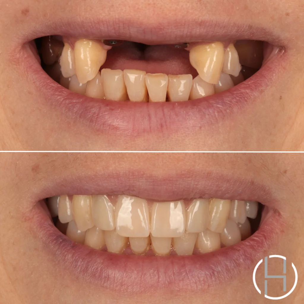 real case dental bridge