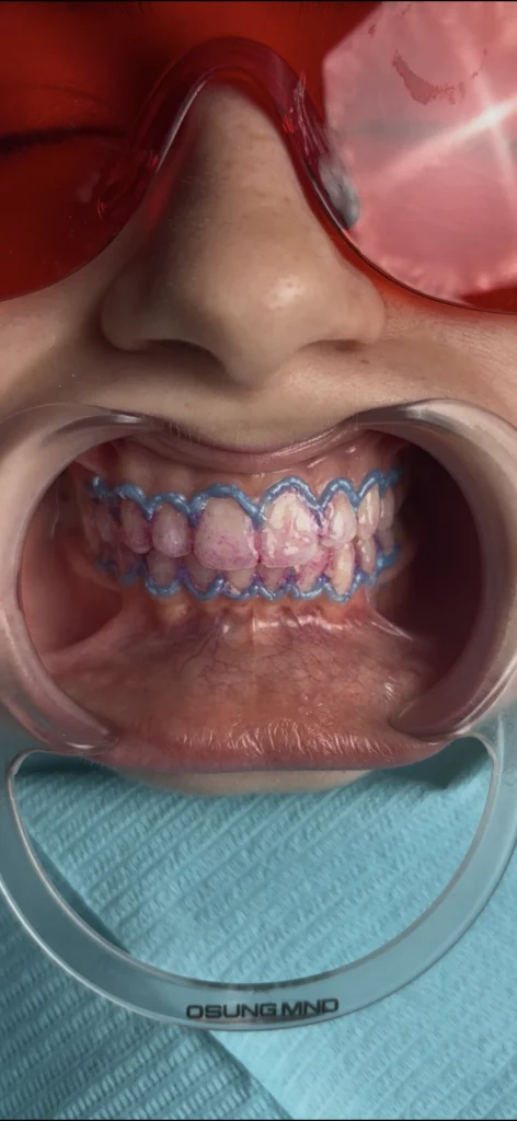 teeth whitening proceedure beirut