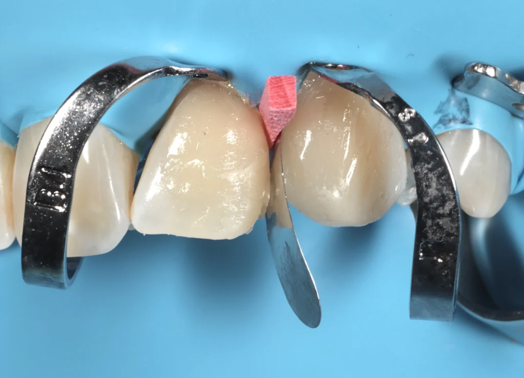 closing the gap between teeth