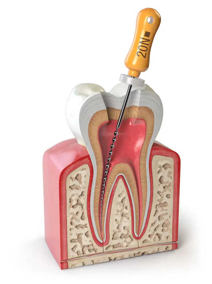 root canal therapy