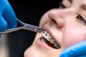 dental braces beirut