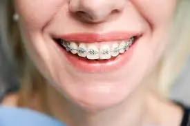 dental braces in beirut