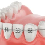 dental braces treatment beirut