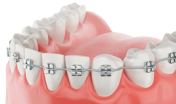 Orthodontic Braces Cost in Beirut (2026): Prices, Treatment Duration & What to Expect dental braces treatment beirut
