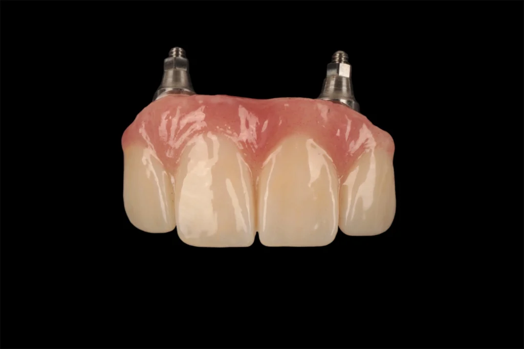 dental bridge on implant