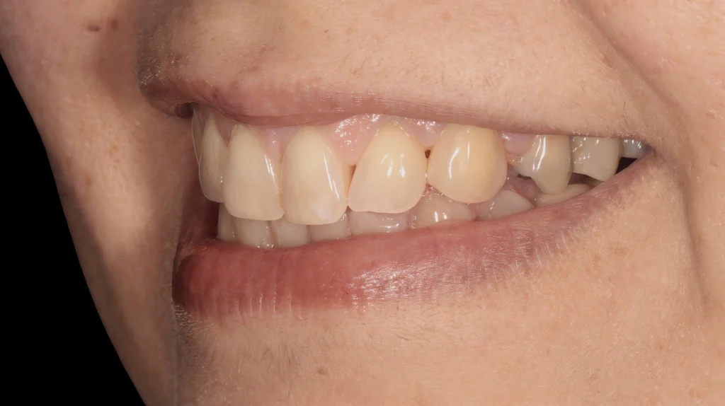 dental diastema closed with composite