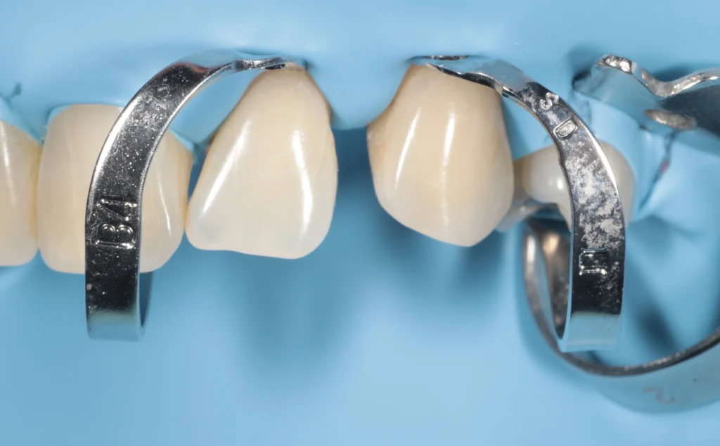 dental diastema closure