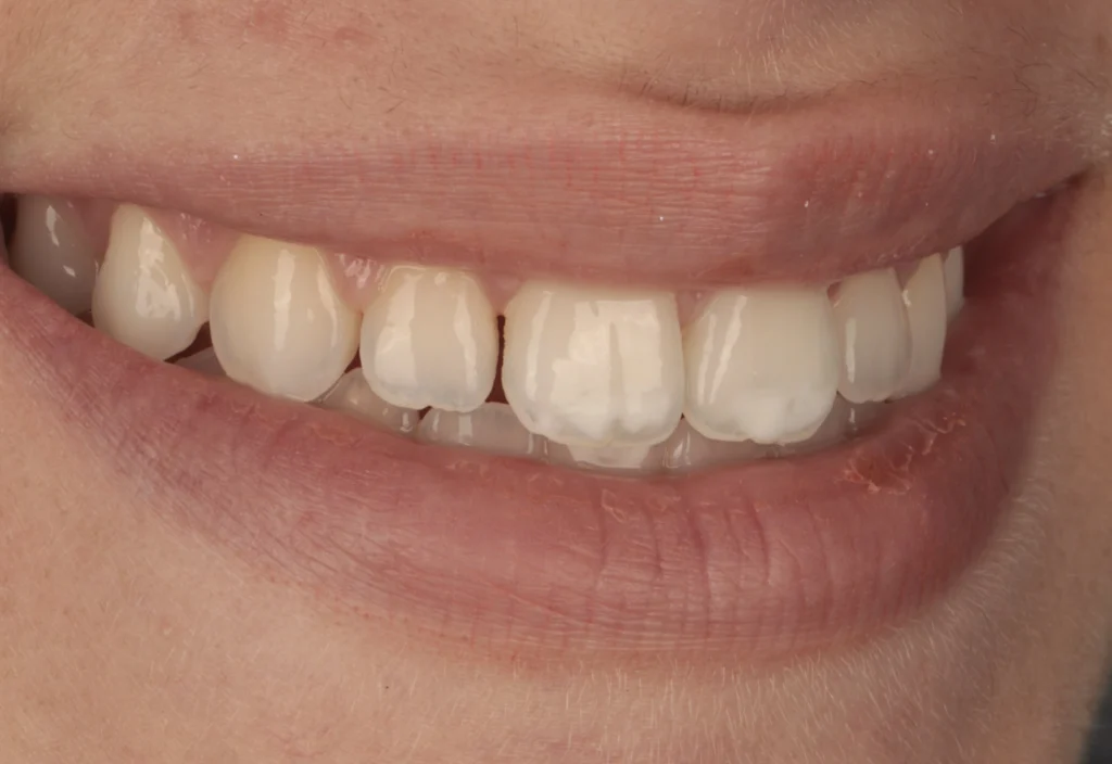 dental white spots