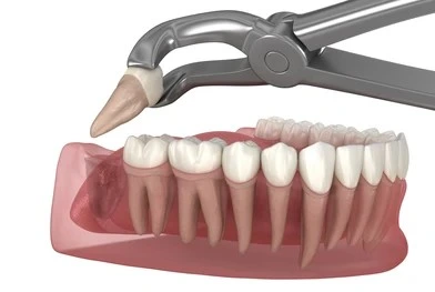 extraction wisdom tooth beirut (1)