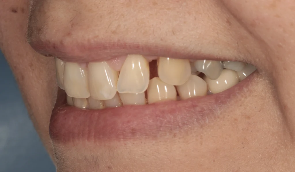 gap between teeth