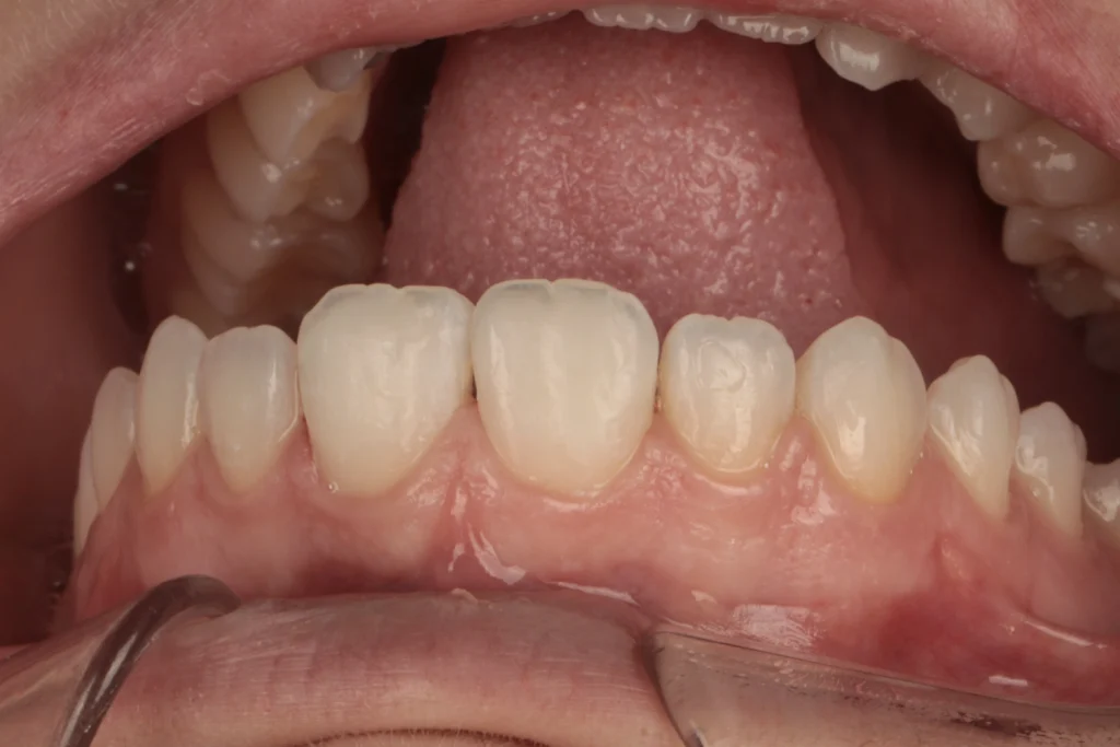 icon resin infiltration