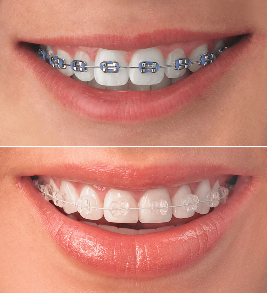metal or ceramic braces beirut