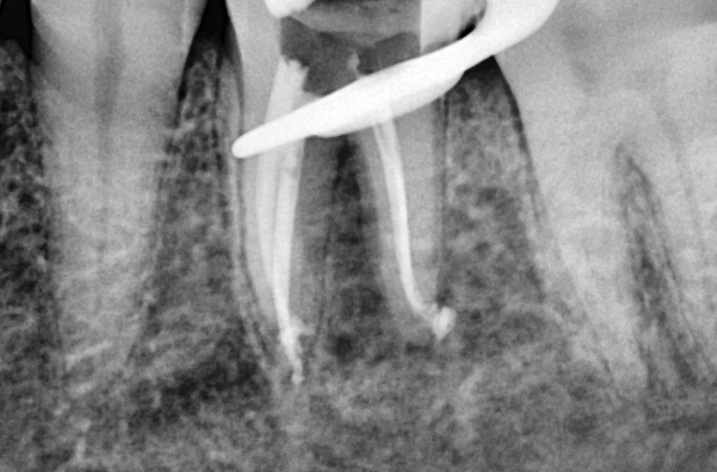 root canal treatment after