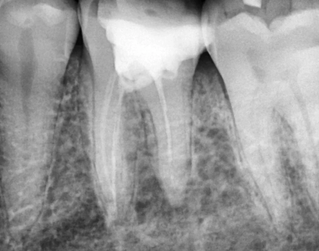 root canal treatment before