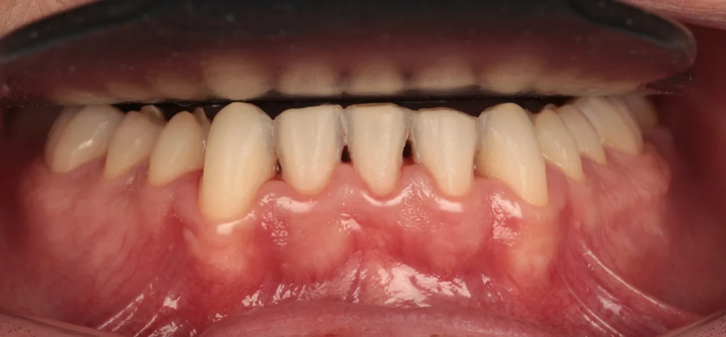 teeth prepared for emax venneers
