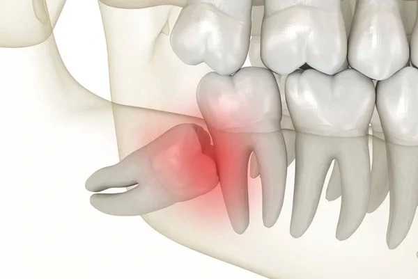 wisdom teeth removal beirut