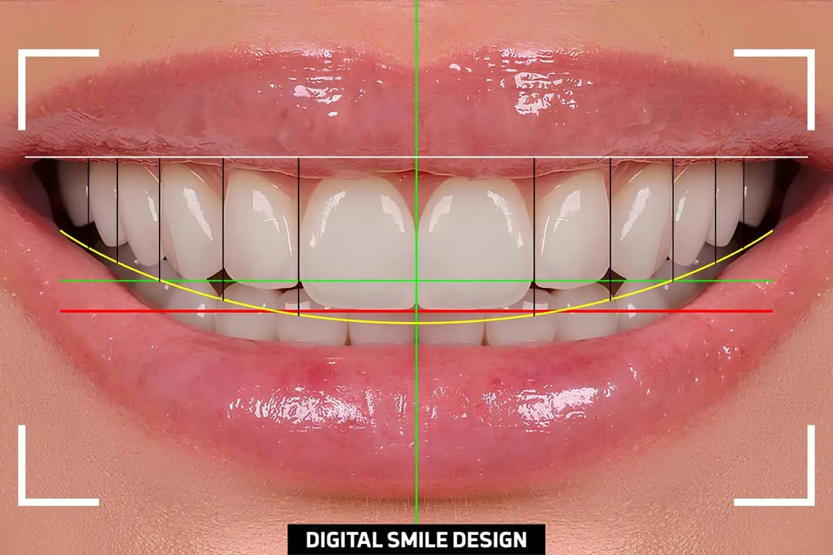 Composite Bonding vs Veneers: Which One Is Right for Your Smile in Beirut? digital smile design beirut