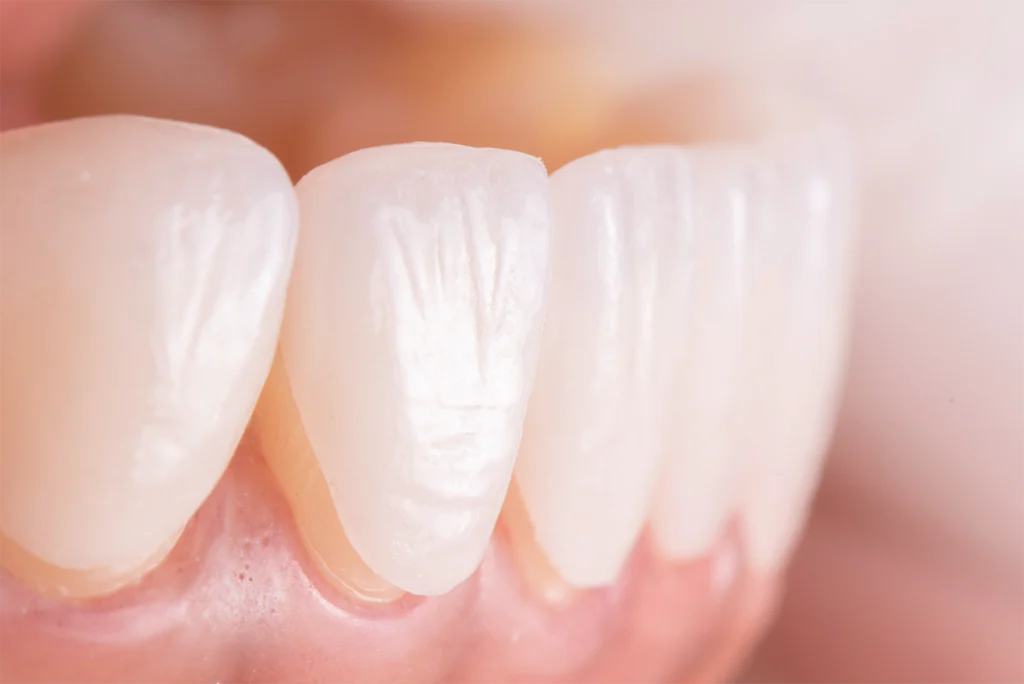 emax laminate veneers