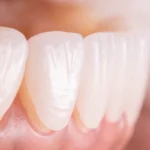 is cosmetic dentistry painful?