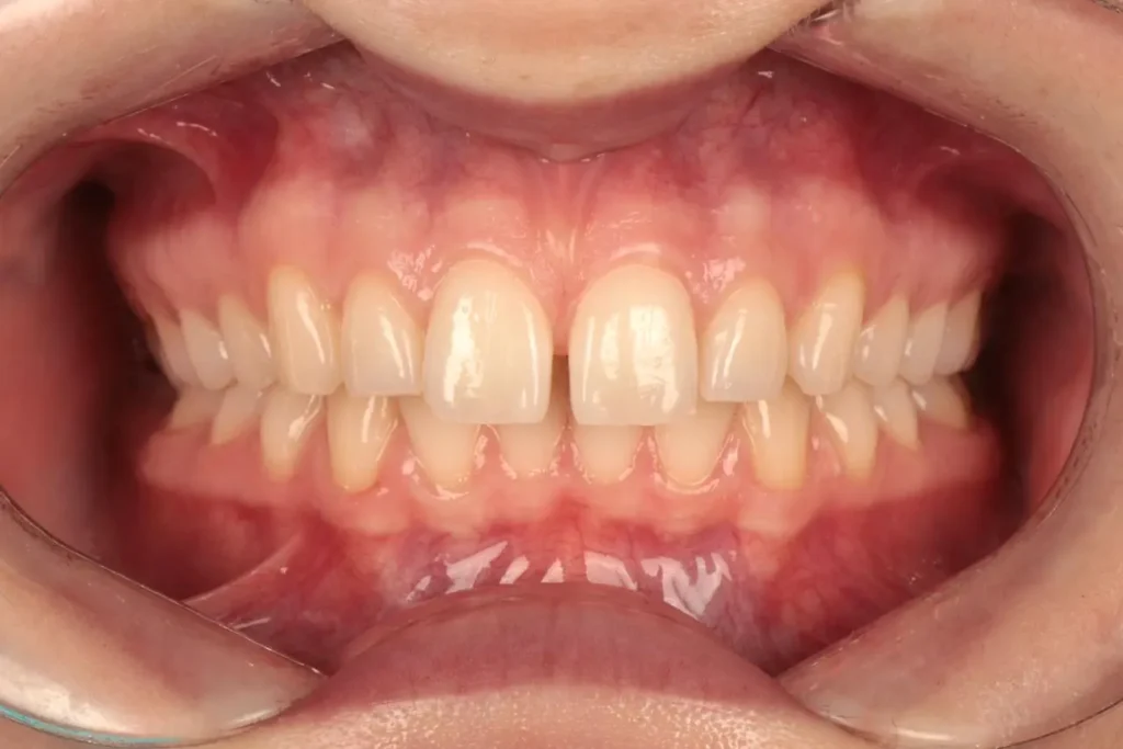 How to Fix a Gap Between Teeth in Beirut: Options & Results teeth gap beirut