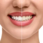 teeth whitening beirut price