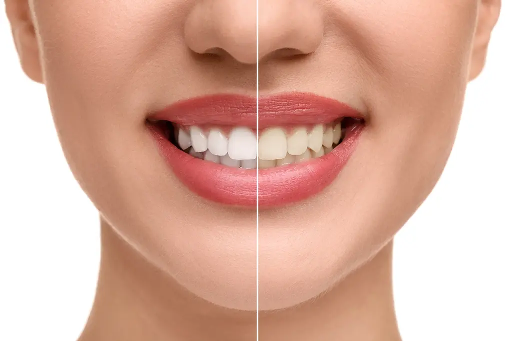 Laser Teeth Whitening Cost in Beirut (2026): Prices, Results & What to Expect teeth whitening beirut price