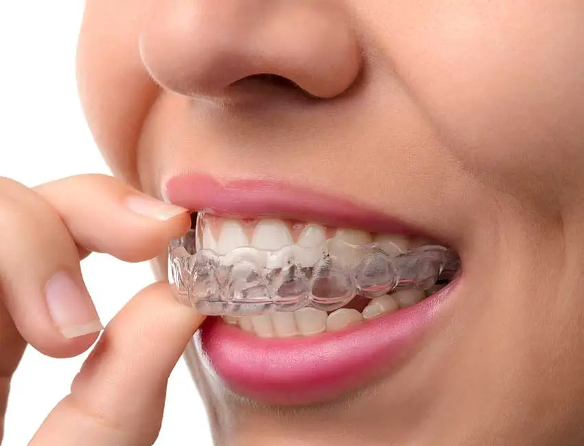 Night Guard Cost in Beirut (2026): Prices, TMJ Treatment & Teeth Grinding Protection nightguard beirut