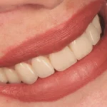 zirconia crowns layered