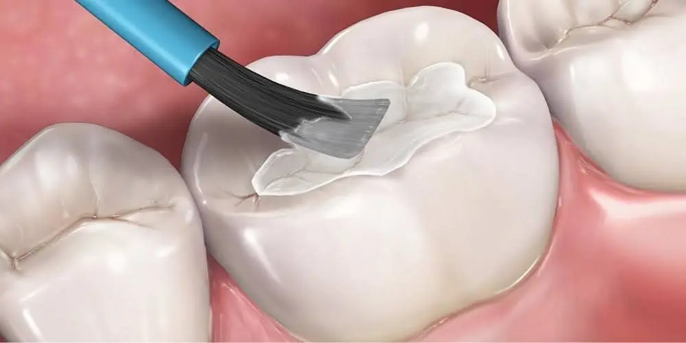 How Can I Prevent Cavities? A Dentist's Complete Guide (2026) dental sealants