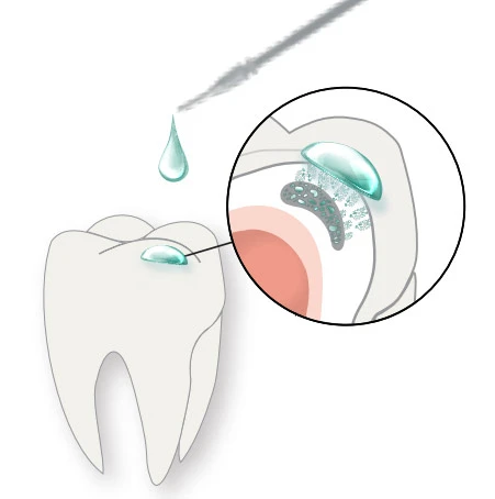 Can Cavities Be Treated Without Drilling? A Beirut Dentist Explains (2026) curodont repair in lebanon