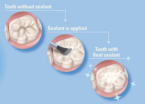 How Can I Prevent Cavities? A Dentist's Complete Guide (2026) dental sealants beirut