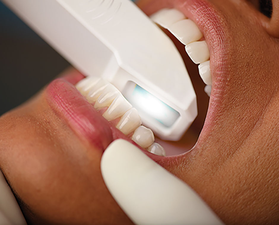 intaoral scan