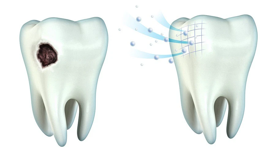 Can Cavities Be Treated Without Drilling? A Beirut Dentist Explains (2026) remove caries without drilling