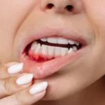 bleeding gums when brushing