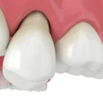 loose tooth