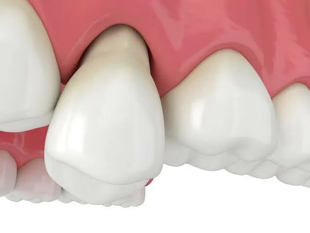 Why Is My Tooth Loose? Can It Be Saved? A Prosthodontist Explains loose tooth